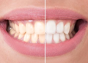 Teeth Whitening in Norwalk, CT